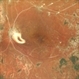 SILICONE OIL FILLED VITRECTOMISED EYE IN A CASE OF TRACTIONAL RETINAL DETACHMENT SILICONE OIL FILLED VITRECTOMISED EYE IN A CASE OF TRACTIONAL RETINAL DETACHMENT