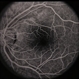 Peripapillary CNVM / Uveitis Peripapillary CNVM / Uveitis