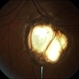 Choroidal Coloboma Choroidal Coloboma