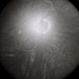 Retinal Capillary Hemangioblastoma Retinal Capillary Hemangioblastoma