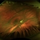 Hypotony Maculopathy Hypotony Maculopathy