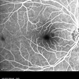 Paracentral Acute Middle Maculopathy Fundus Fluorescein Angiography Early Phase Paracentral Acute Middle Maculopathy Fundus Fluorescein Angiography Early Phase