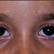 Congenital Ocular Melanosis