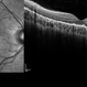 Serpiginous Choroidal Atrophy Serpiginous Choroidal Atrophy