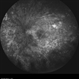 Behcet's Disease