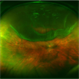 Bullous Retinal Detachment Bullous Retinal Detachment