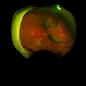 Giant Retinal Tear
