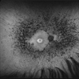 Retinitis Pigmentosa