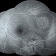 Fundus Fluorescein Angiography of Choroidal Metastases Fundus Fluorescein Angiography of Choroidal Metastases