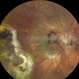 PCV and Peripheral Hemorrhagic Choroidopathy PCV and Peripheral Hemorrhagic Choroidopathy