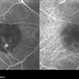 Retinal Angiomatous Proliferation Retinal Angiomatous Proliferation
