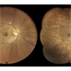 Proliferative Diabetic Retinopathy S/P Pan Retinal Photocoagulation Proliferative Diabetic Retinopathy S/P Pan Retinal Photocoagulation