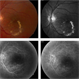 Vascular Anormalities Vascular Anormalities