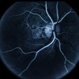 CNVM / Cholesterolemia