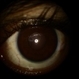 Left -Anterior Segment
