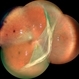 Giant Retinal Tear