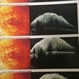 Hamartoma of the Retina Hamartoma of the Retina