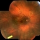Fluocinolone Acetonide Intravitreal Implant in Vitreous Fluocinolone Acetonide Intravitreal Implant in Vitreous