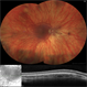 Ocular Albinism Ocular Albinism