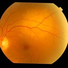 Choroidal Metastasis From Pulmonary Adeno Carcinima - Retina Image Bank