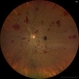 Leukemic Retinopathy Leukemic Retinopathy