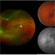 Retinal Folds After Surgery Retinal Folds After Surgery