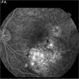 Choroidal Osteoma Choroidal Osteoma