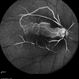 Central Retinal Artery Occlusion with Cilioretinal Artery Sparing Central Retinal Artery Occlusion with Cilioretinal Artery Sparing