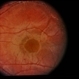 CGD / Chronic Granulomatous Disease