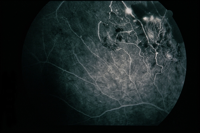 Eales Disease Retina Image Bank