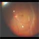 Intra-operative still of PFCL bubble in RD Surgery Intra-operative still of PFCL bubble in RD Surgery