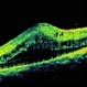 Posterior Microphthalmos Posterior Microphthalmos