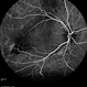 Multifocal Exudative Detachments Due to VKH Multifocal Exudative Detachments Due to VKH