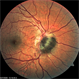 Optic Nerve Melanocytoma