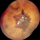 Subhyaloid Hemorrhage With Vitreous Hemorrhage