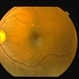 Choroidal Hemangioma Choroidal Hemangioma
