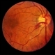 Preretinal Vascular Loop