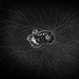 Focal Chorioretinitis