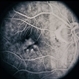 Adult Foveomacular Dystrophy / Pattern Adult Foveomacular Dystrophy / Pattern
