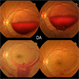 Valsalva Retinopathy