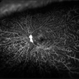 Proliferative Diabetic Retinopathy with Retinal Ischemia Proliferative Diabetic Retinopathy with Retinal Ischemia