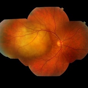 Choroidal Metastasis - Retina Image Bank