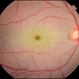 Arterial Occlusion Arterial Occlusion