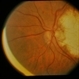 Peculiar Acute Subretinal Fibrosis Peculiar Acute Subretinal Fibrosis