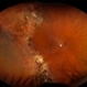 Chronic RD with Retinal Dialysis