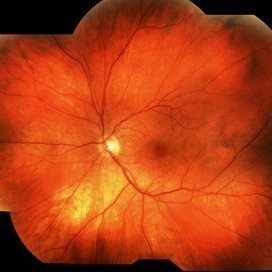 Cancer Associated Retinopathy (CAR) - Retina Image Bank