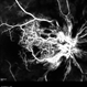 Early Phase of FA in a Case of Combined CRAO and CRVO Early Phase of FA in a Case of Combined CRAO and CRVO