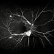 Proliferative Diabetic Retinopathy  with Severe Ischemia