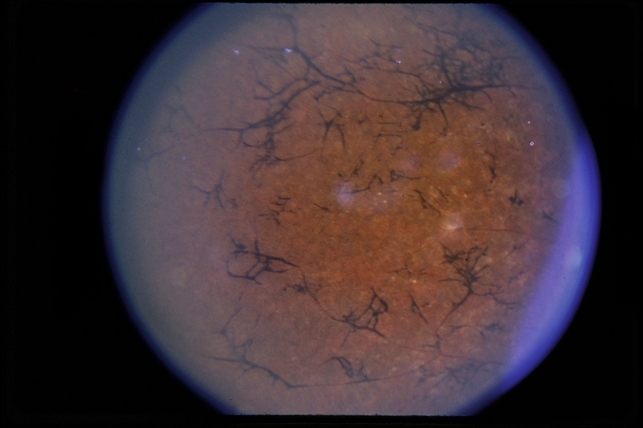 Retinitis Pigmentosa Pubmed Retinitis Pigmentosa Pubmed