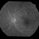 BRVO With Non-Perfusion